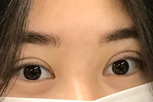 눈재수술 후기