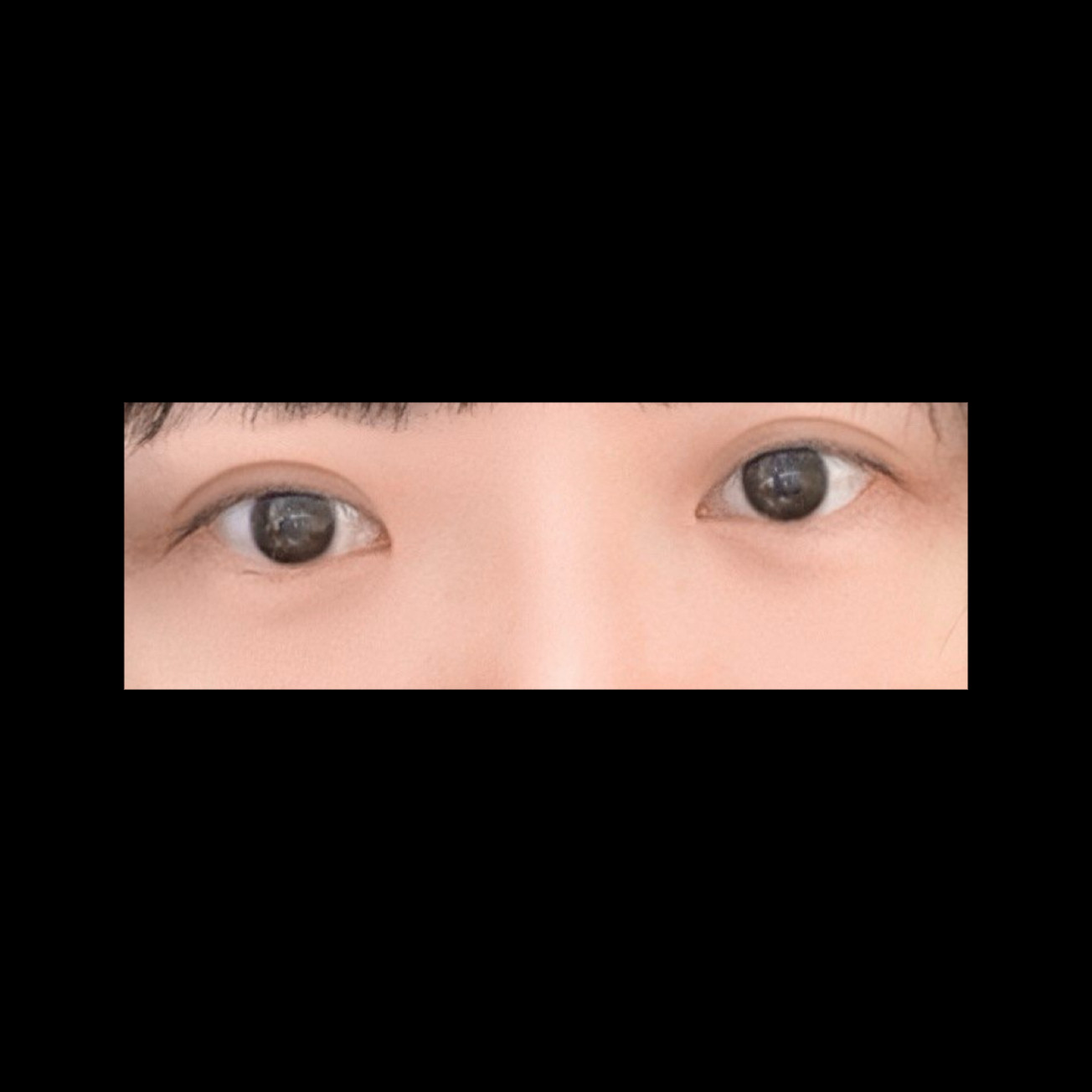 눈재수술 후기
