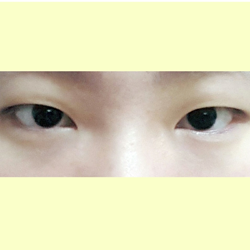 쌍꺼풀(절개) 후기