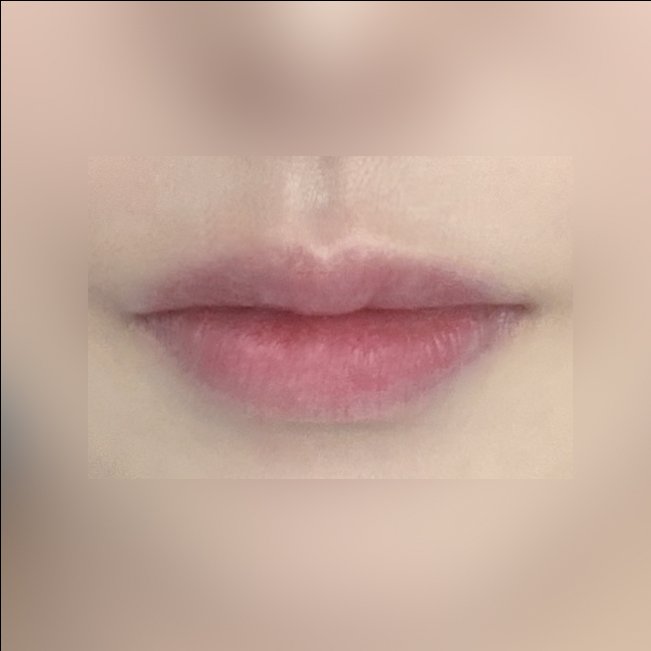 입꼬리성형 후기