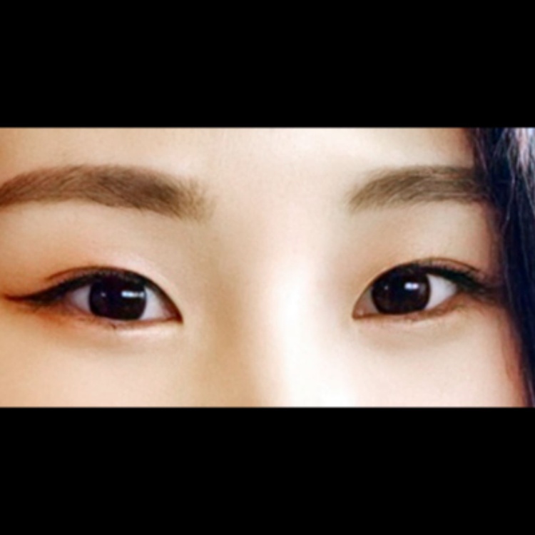 쌍꺼풀(절개) 후기