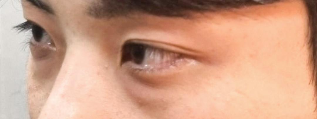 눈밑지방재배치 후기