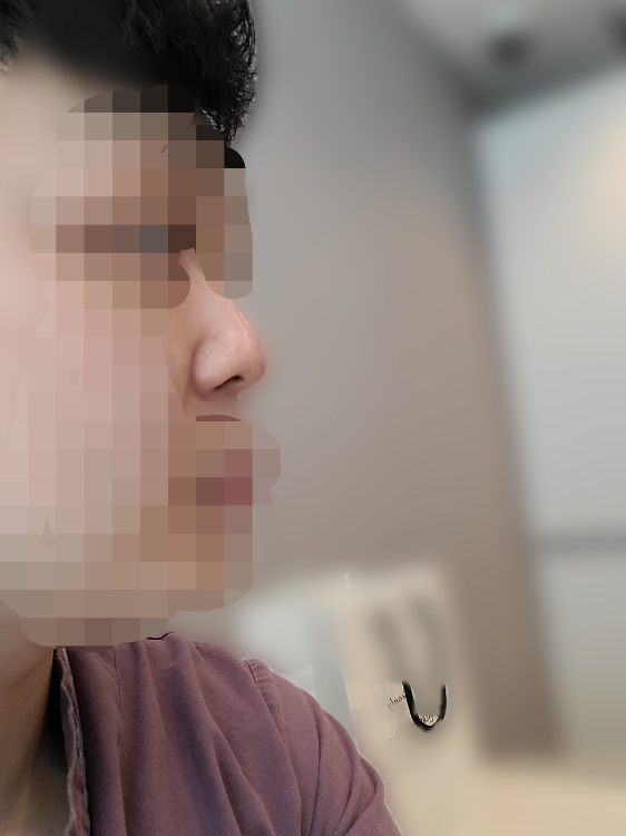 콧볼축소 후기