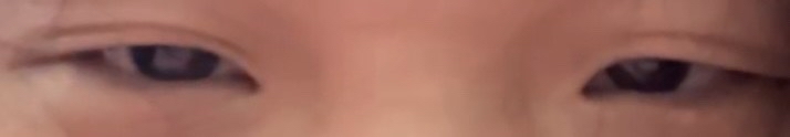 쌍꺼풀(절개) 후기