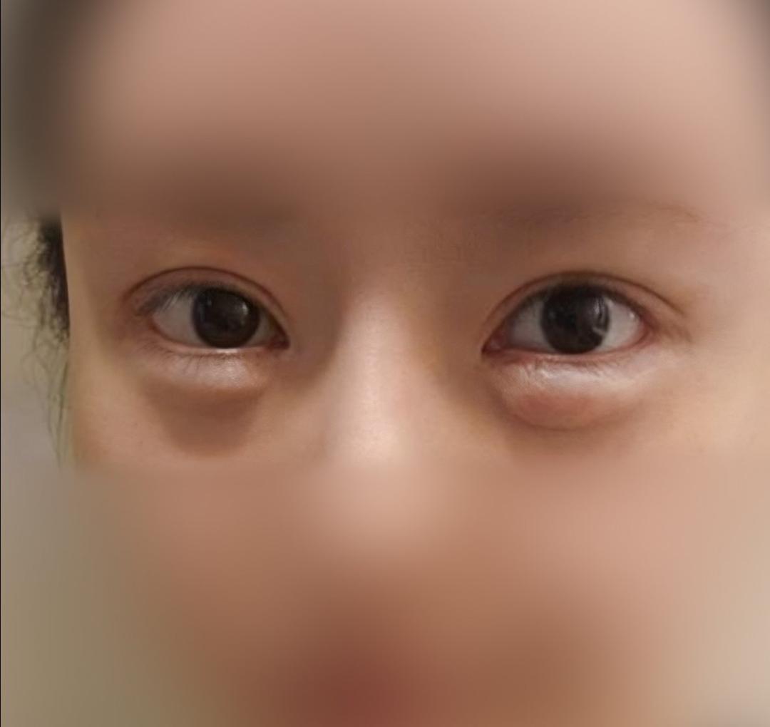 눈밑지방재배치 후기