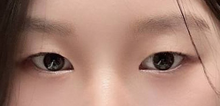쌍꺼풀(절개) 후기