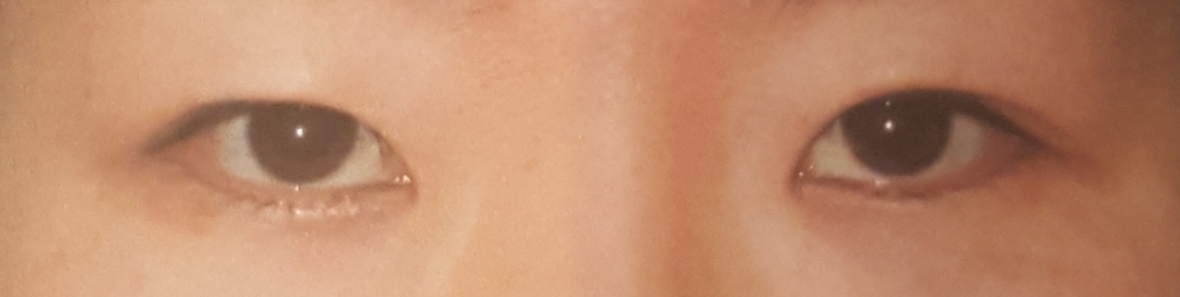 쌍꺼풀(절개) 후기