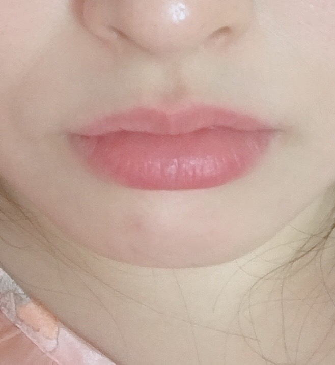 입꼬리성형 후기