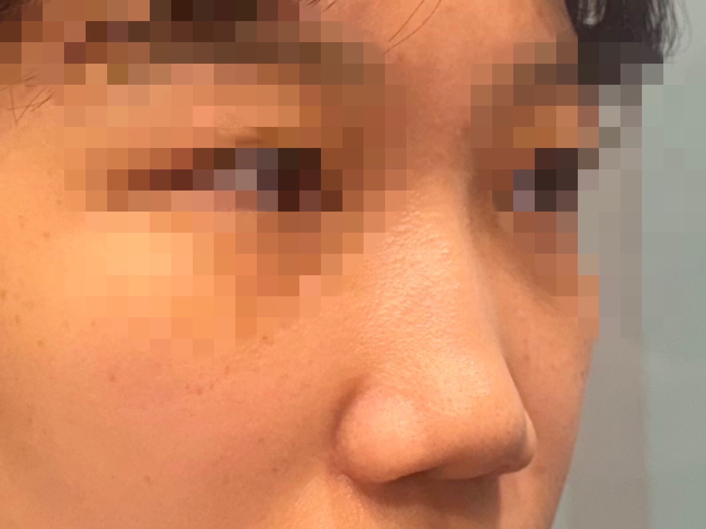 코절골술 후기