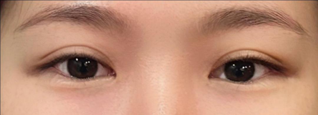 눈재수술 후기