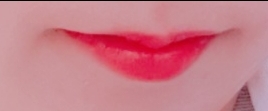 입꼬리성형 후기