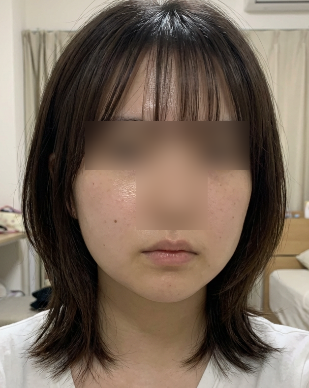 온다리프팅 후기