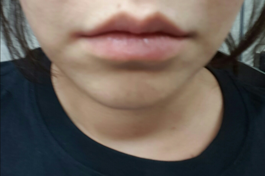 입꼬리성형 후기