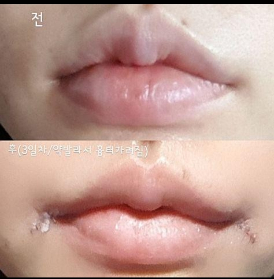 입꼬리성형 후기
