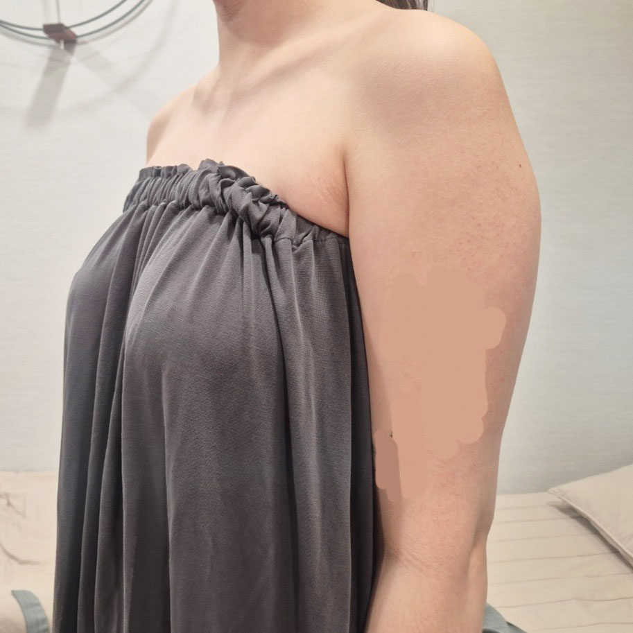 팔지방흡입 후기