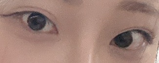 쌍꺼풀(절개) 후기