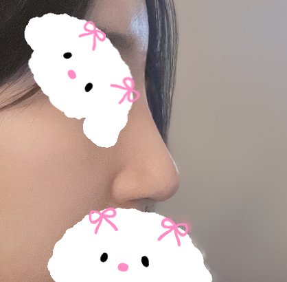 코재수술 후기