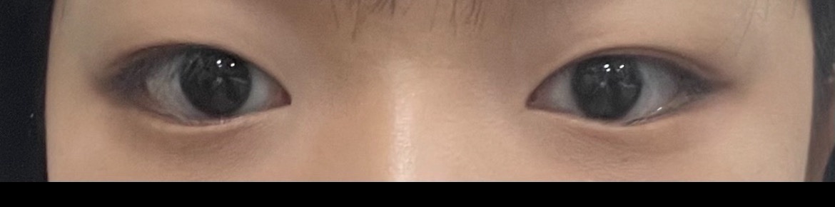 쌍꺼풀(매몰) 후기