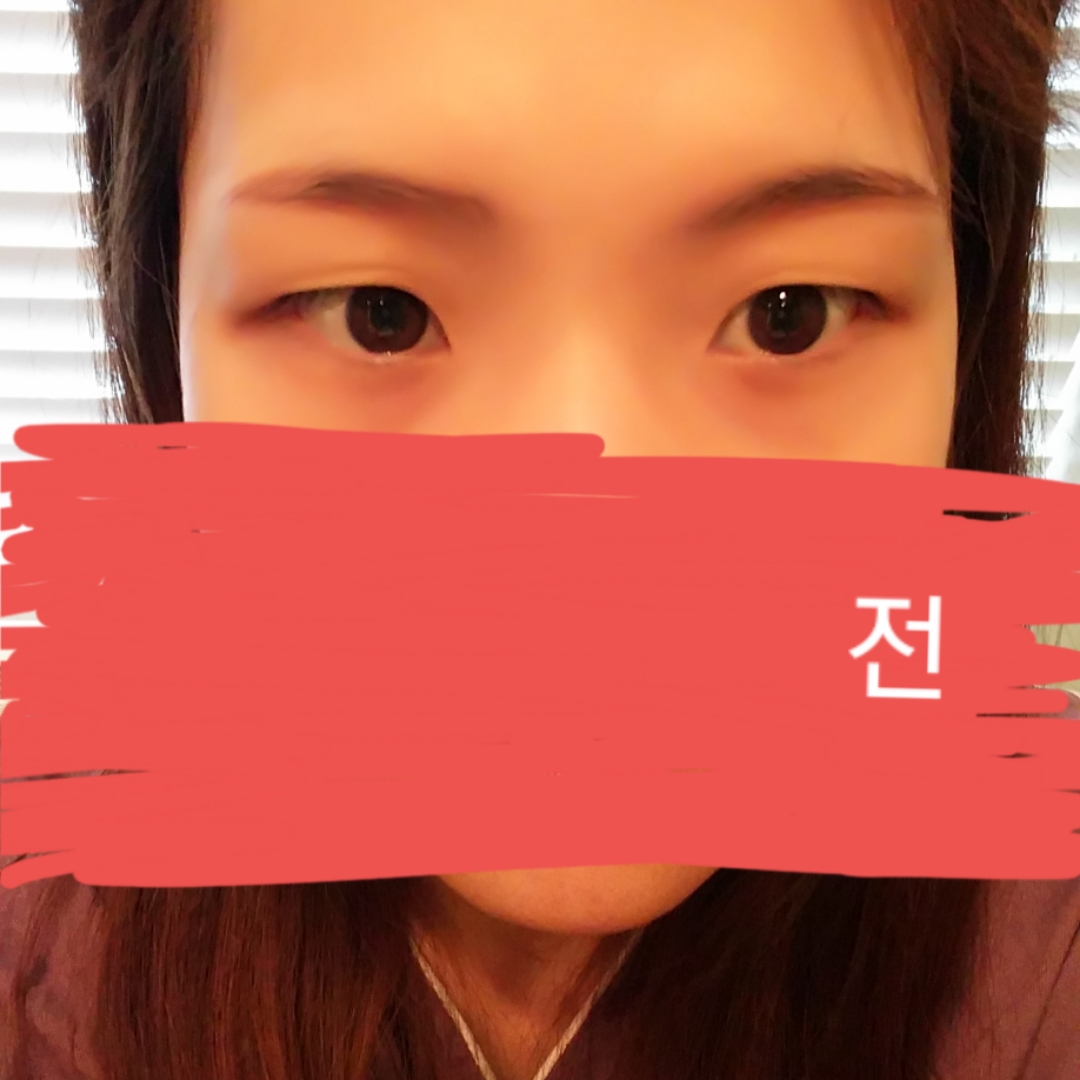 쌍꺼풀(절개) 후기