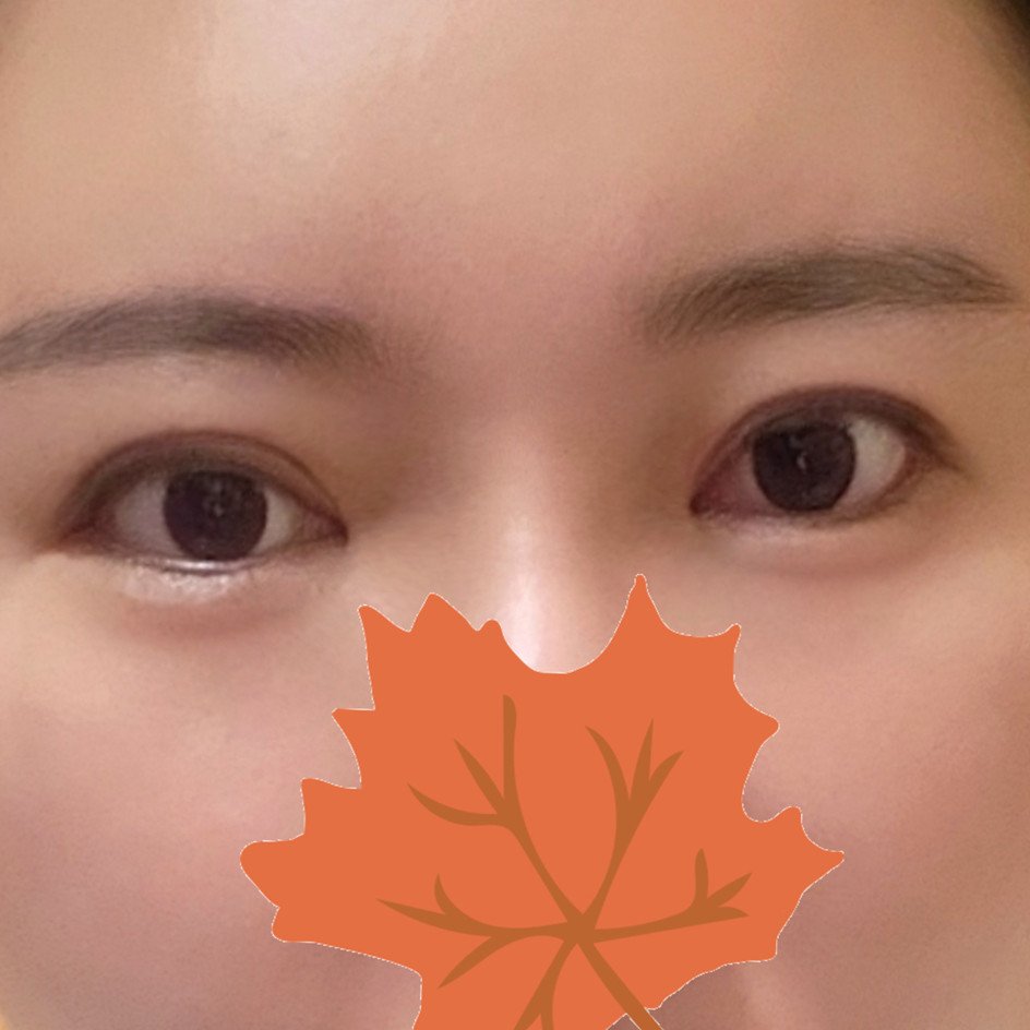 눈재수술 후기