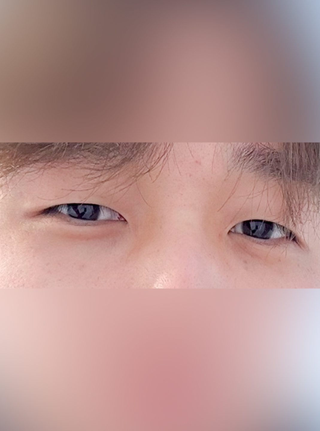 쌍꺼풀(절개) 후기
