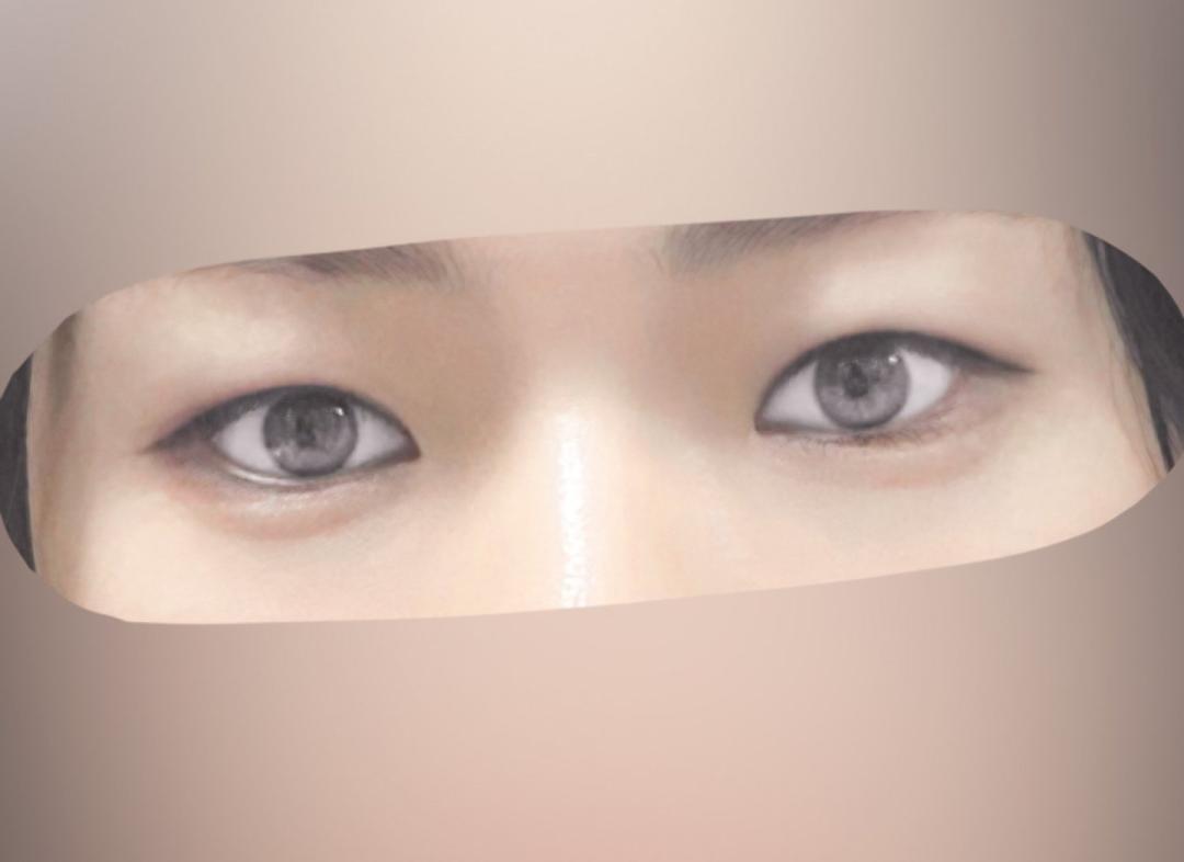 쌍꺼풀(절개) 후기