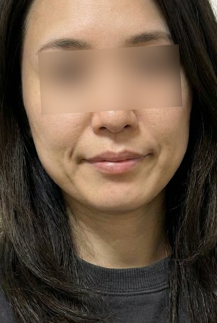 온다리프팅 후기