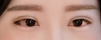 눈재수술 후기