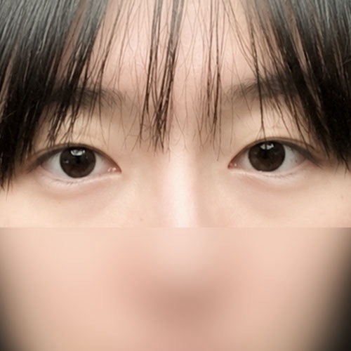 쌍꺼풀(자연유착) 후기