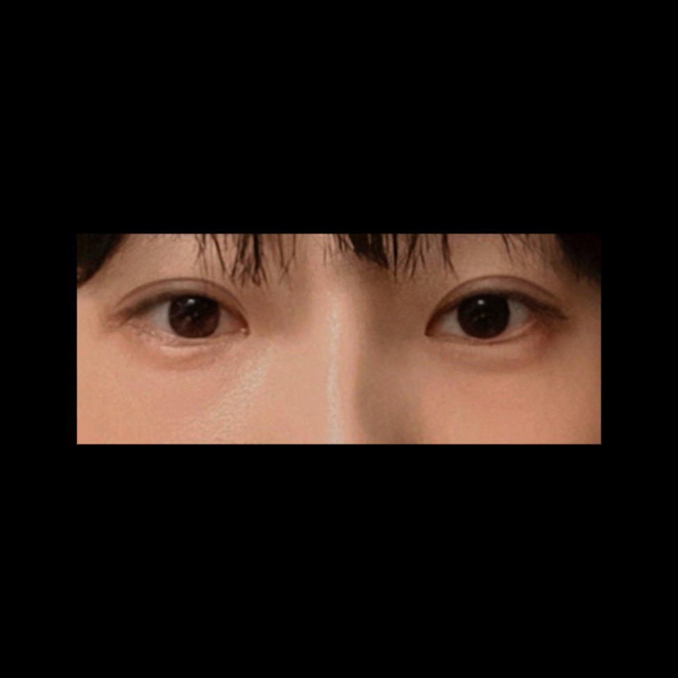 눈재수술 후기