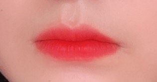 입꼬리성형 후기