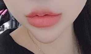 인중축소술 후기