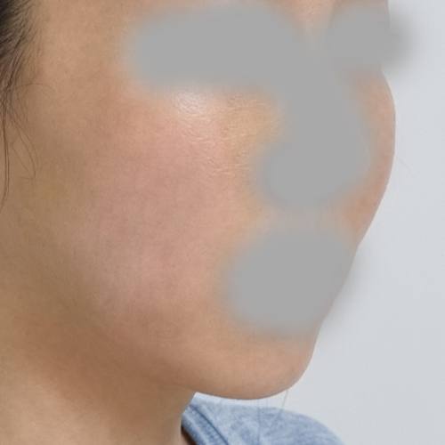 실리프팅 후기