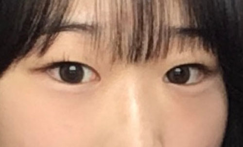 쌍꺼풀(자연유착) 후기