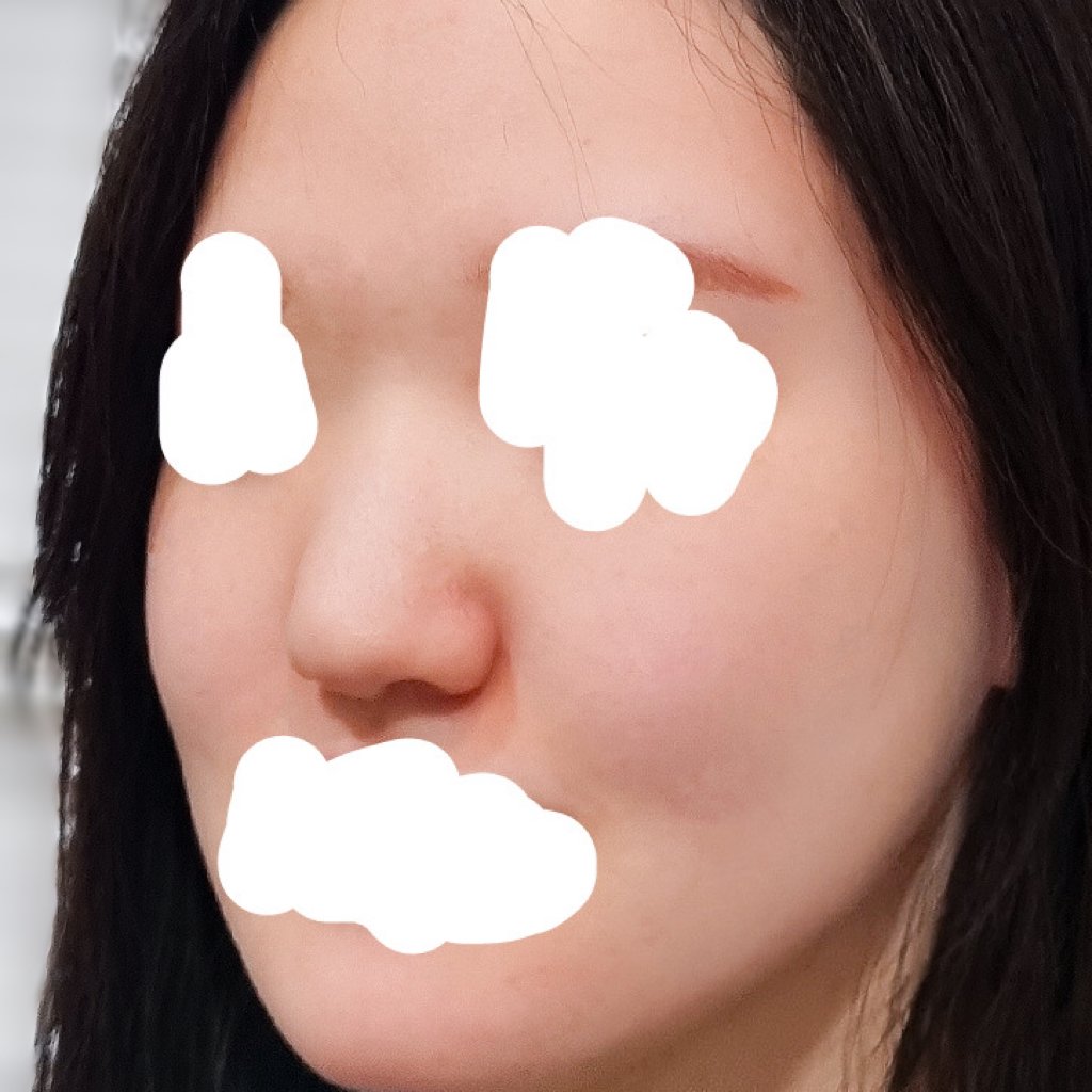 코끝(기증연골) 후기