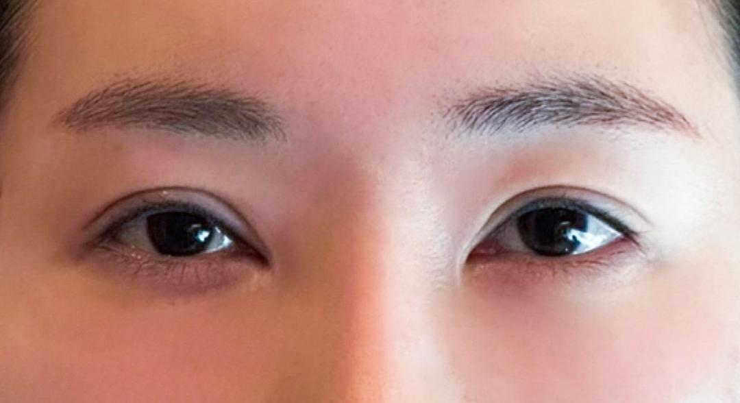 눈재수술 후기