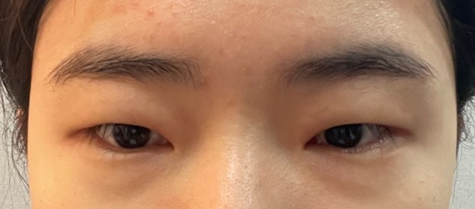 밑트임 후기