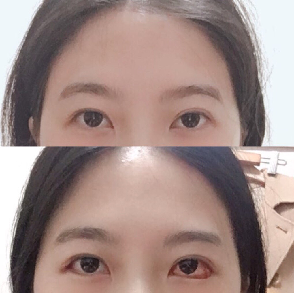 밑트임 후기