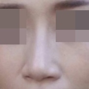 코재수술 후기