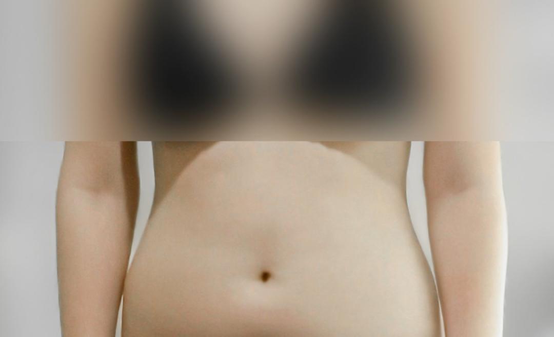 복부지방흡입 후기