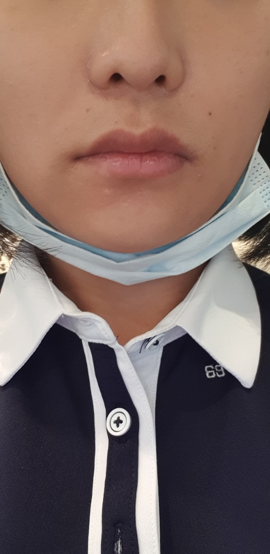 입꼬리성형 후기