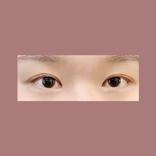 눈재수술 후기