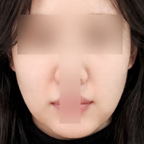 실리프팅 후기