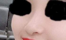 콧대(보형물) 후기