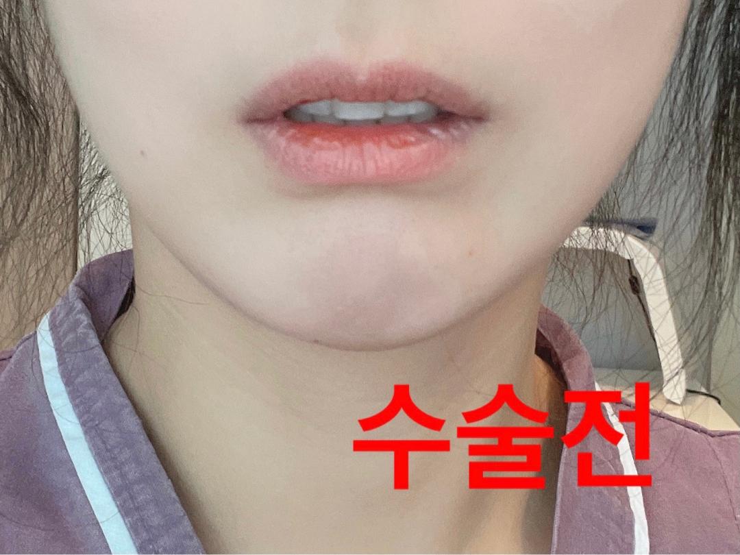 입꼬리성형 후기