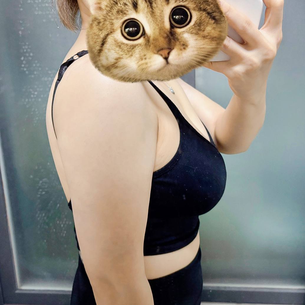 팔지방흡입 후기