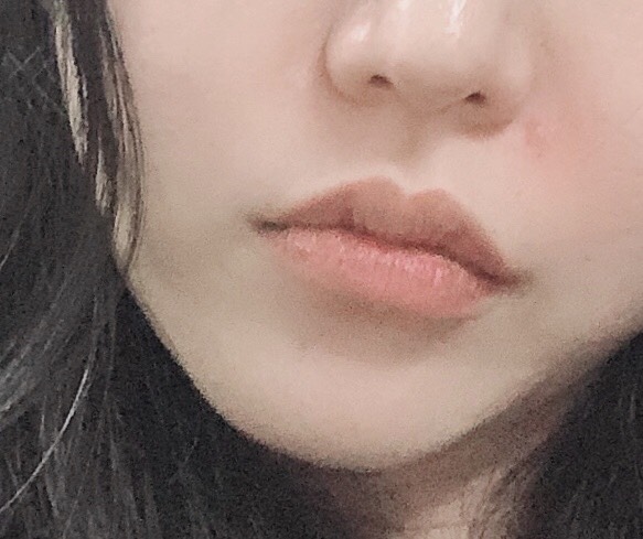 인중축소술 후기