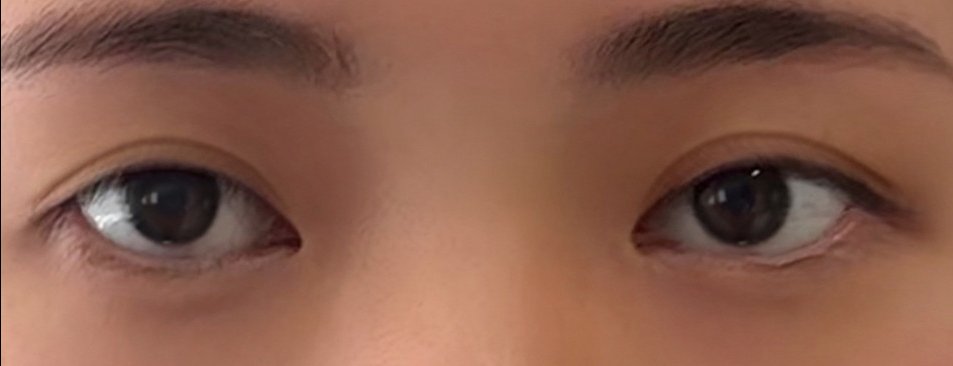 눈재수술 후기