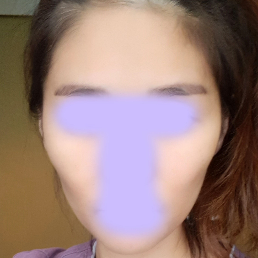 광대축소(앞광대) 후기