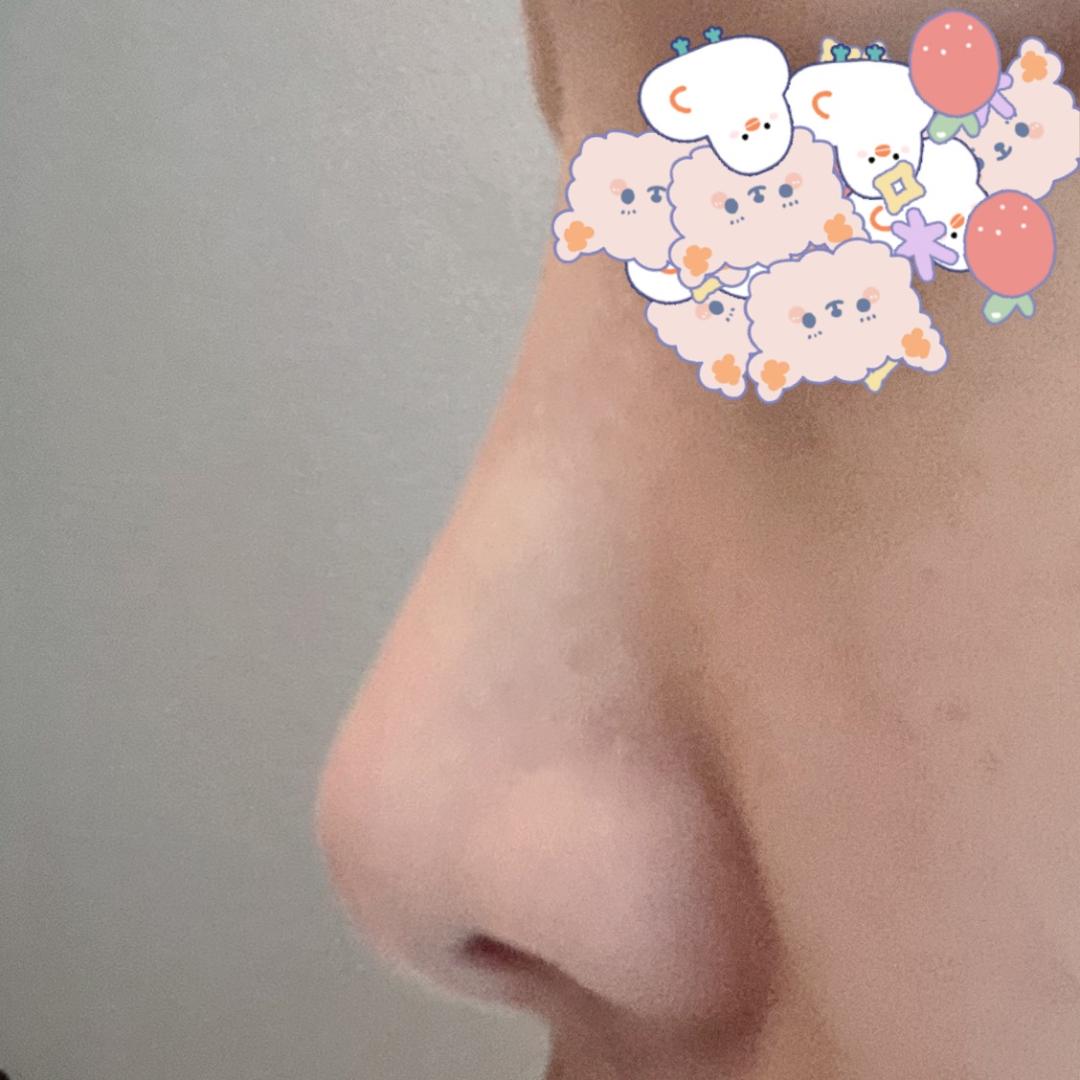 콧대(보형물) 후기